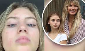 Bum's the word put your bum away heidi klum! Heidi Klum S Daughter Leni 16 Gets Real About Her Acne As She Reveals Her Bad Skin On Instagram Daily Mail Online