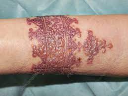 Maybe you would like to learn more about one of these? Allergic Reaction To Henna Stock Image C047 5002 Science Photo Library