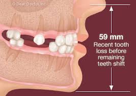 About a year ago i fell off my bike and landed with the palm of my hands on a gravel bike trail. Consequences Of Tooth Loss Dental Implants