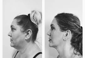 Facial Liposuction in Albuquerque