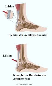 Ein achillessehnenriss (achillessehnenruptur) ist eine durchtrennung der achillessehne, die meistens durch eine überbeanspruchung der sehne bei einer sportlichen belastung entsteht. Achillessehnenriss Dauer Achillessehneruptur Achillessehnenentzundung