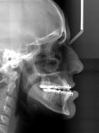Maybe you would like to learn more about one of these? Corrective And Orthognathic Jaw Surgery Dr Richard W Joseph