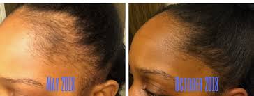 The average person loses about 100 hairs a day, but not all at once, so you don't notice them. I Lost My D Mn Edges Postpartum Hair Loss Shedding Real Mom Ish