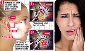 A slipped disc in the jaw is another common cause of tmj disorder. Clicking Jaw Pain Fixed With A Single Invisible Stitch That Leaves No Scars Daily Mail Online