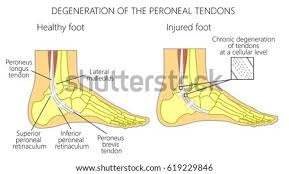 1) severe pain and swelling of the ankle; Shutterstock Puzzlepix