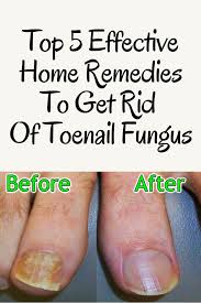 Top 5 Effective Home Remedies To Get Rid Of Toenail Fungus Toenail Fungus Home Remedies Toe Fungus Remedies Toenail Fungus