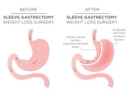 Gastric sleeve surgeons practicing in florida and general information on gastric sleeve surgery, including cost and results. Gastric Sleeve Blossom Bariatrics