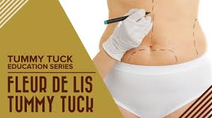 Longevity of arm lift surgery results; Planning Tummy Tuck