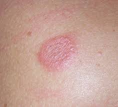 What do bites look like? How To Get Rid Of Spiders In The House Treat Spider Bites And What To Do If You Re Overwhelmed By Creepy Crawlies