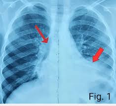 Image result for Air Bronchogram
