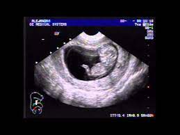 Ultrasonido 11 Semanas Youtube