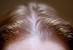 Female Hair Loss Back Of Head