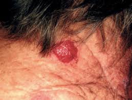 If breast cancer is diagnosed at an early enough stage, it's treatable. Cutaneous Metastasis Dermnet Nz