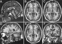 Image result for Pallidotomy