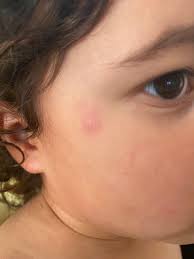 Image result for Papular urticaria