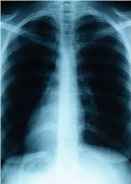 Image result for lung cancer xray