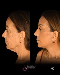 14 dias após cirurgia do Adrian Adrian cruzou o oceano vindo da Inglaterra  em busca de um rejuvenescimento que fosse além da estética — ele queria  recuperar estrutura, leveza e funcionalidade. Planejamos