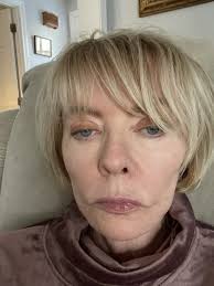 Recently had Neogen Plasma Treatment