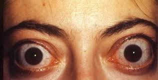 Apr 05, 2019 · graves' disease is the most common autoimmune condition in the u.s. Thyrotoxicosis And Hyperthyroidism Concise Medical Knowledge