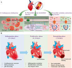 Image result for Myocardial Infarction Stabilization
