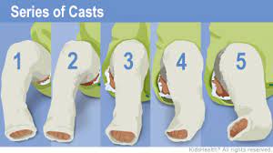 Start studying ponseti method for clubfoot. The Ponseti Method Casting Phase For Parents All Children S Hospital Xml
