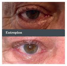 Image result for Entropion