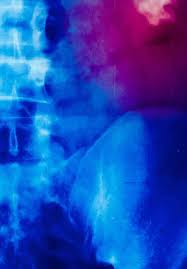 Endometriosis is the abnormal growth of endometrial cells outside the uterus. Differential Diagnosis For Female Pelvic Masses Intechopen