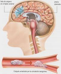 Check spelling or type a new query. Encefalitis Cuida Tu Salud Con Diane Perez