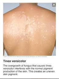 This infection can occur due to excessive sweat, oily skin or. Tinea Versicolor Is A Fungal Ahmed Nageh Pharmacy Apteka Facebook
