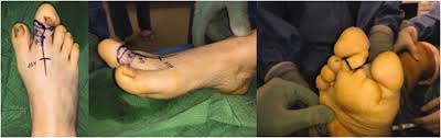 Image result for toe amputation