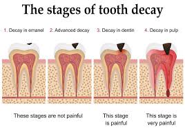Cavities are permanently damaged areas in the hard surface of your teeth that develop into tiny openings or holes. Is It Possible To Reverse Tooth Decay Governor S Park Dental Group