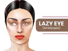 A lazy eye develops when there's a breakdown in how the brain and the weak eye work together. Lazy Eye Amblyopia Causes Symptoms Risk Factors Diagnosis And Treatment Boldsky Com