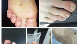 Carl nassib is an american football professional player. Researchers Discover New Coronavirus Symptoms Feet Lesions