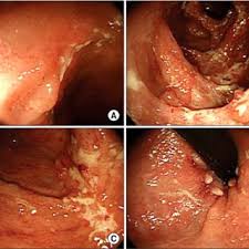 Image result for itchy skin rectum