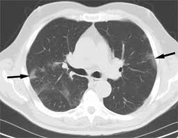 Aspergillosis, cryptococcosis, and mucormycosis are the most common opportunistic fungal infections that can mimic lung cancer. Review Of The Chest Ct Differential Diagnosis Of Ground Glass Opacities In The Covid Era Radiology