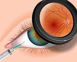 So, it's important to know what the side effects are. What Is Avastin Eye Injection Eye Health Nepal