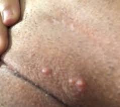 Vaginal bumps could also point to an sti like genital warts or herpes. Ingrown Hair Or Herpes Genital Herpes Simplex Forums Patient
