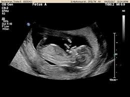 How did you feel at 13 weeks? 1 3 Weeks Pregnant Ultrasound Pictures Novocom Top