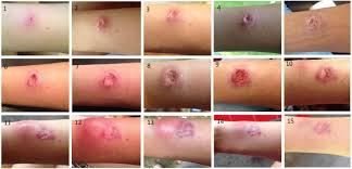 My Battle With A Flesh Eating Parasite Called Leishmaniasis In The Field Earth Touch News