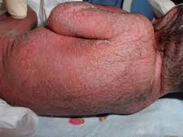 This initial stage is followed by suppression of the immune system. Sepsi Medicinalive