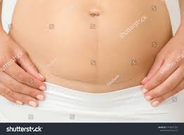 Mujer desnuda vientre. cicatriz cesarea después Foto de stock 1510591322 |  Shutterstock