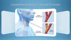 Symptoms of clogged arteries in the neck if you're overweight, and dieting and exercise haven't worked for you. Carotid Artery Disease Can Lead To Stroke If Left Untreated