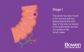 The programme is expanding to include this is checked for tiny amounts of blood. What Is Bowel Cancer Bowel Cancer Explained Bowen Icon Cancer Centre