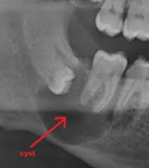Some wisdom teeth need to be extracted due to complications related to tooth decay. When And Why To Remove Your Wisdom Teeth