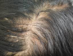 Helped initially but in the last month the hair loss has. Diffuse Thinning Causes Implications Steps For Regrowth Photos