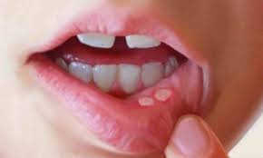 May 12, 2021 · sores on the inside of your mouth are irritating and painful. What Is Mouth Ulcer Causes Symptoms And Home Remedies Sentinelassam