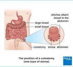 Stoma Care and Living with a Colostomy | Bupa UK