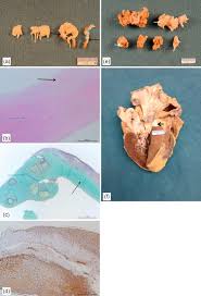 Image result for Dexfenfluramine