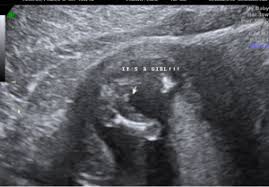 Ultrasound tech ultrasound sonography baby pregnancy tips. Gender Discrepancy Confused Complications Forums What To Expect