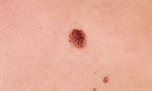 Moles - Skin Surgery Clinic